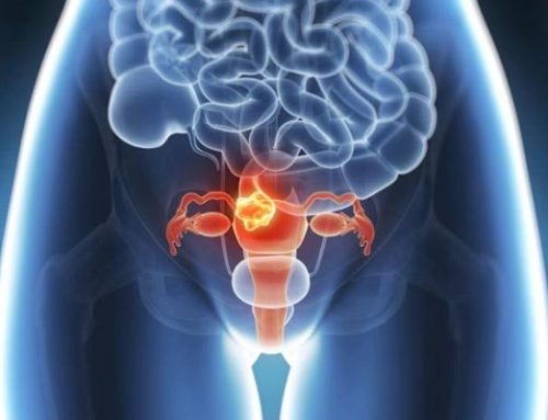 Investigadores hallan información nueva sobre cánceres endometriales agresivos.